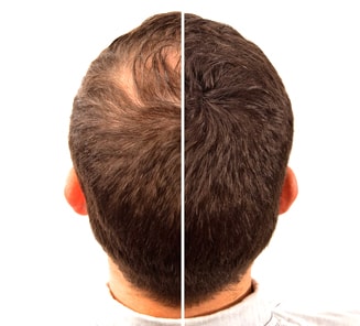 راه های جلوگیری از ریزش مو در مردان